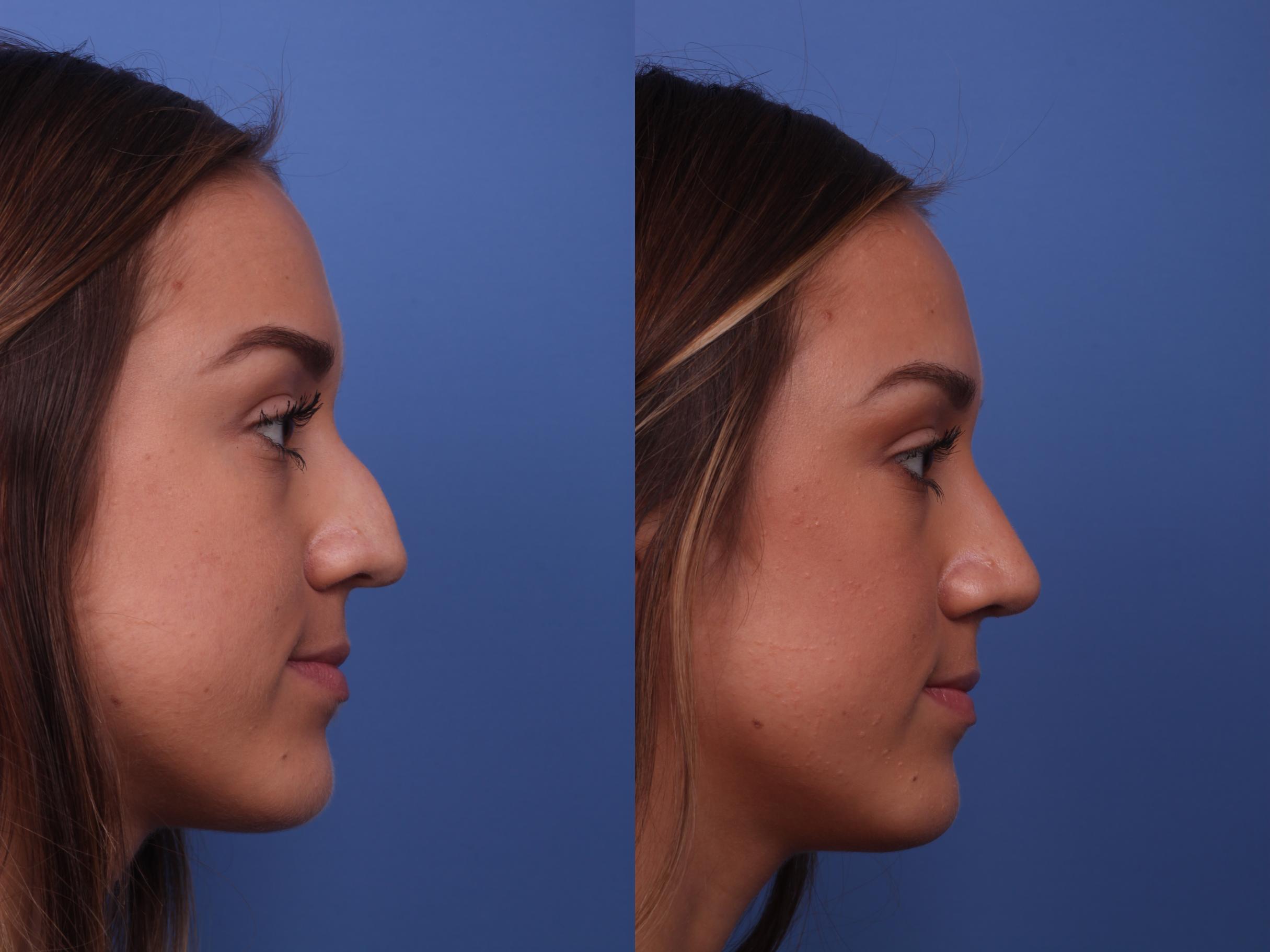 The Aging Rhinoplasty: How to Address Nasal Aesthetics as We Age post thumbnail image