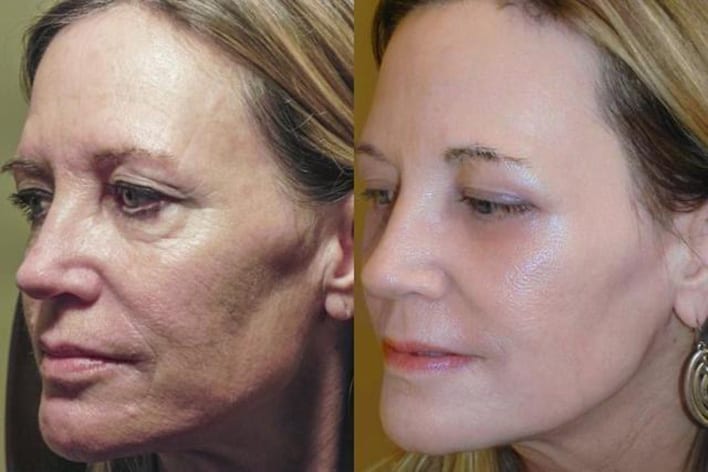 Fotona face lifting: The perfect solution for a more youthful appearance post thumbnail image