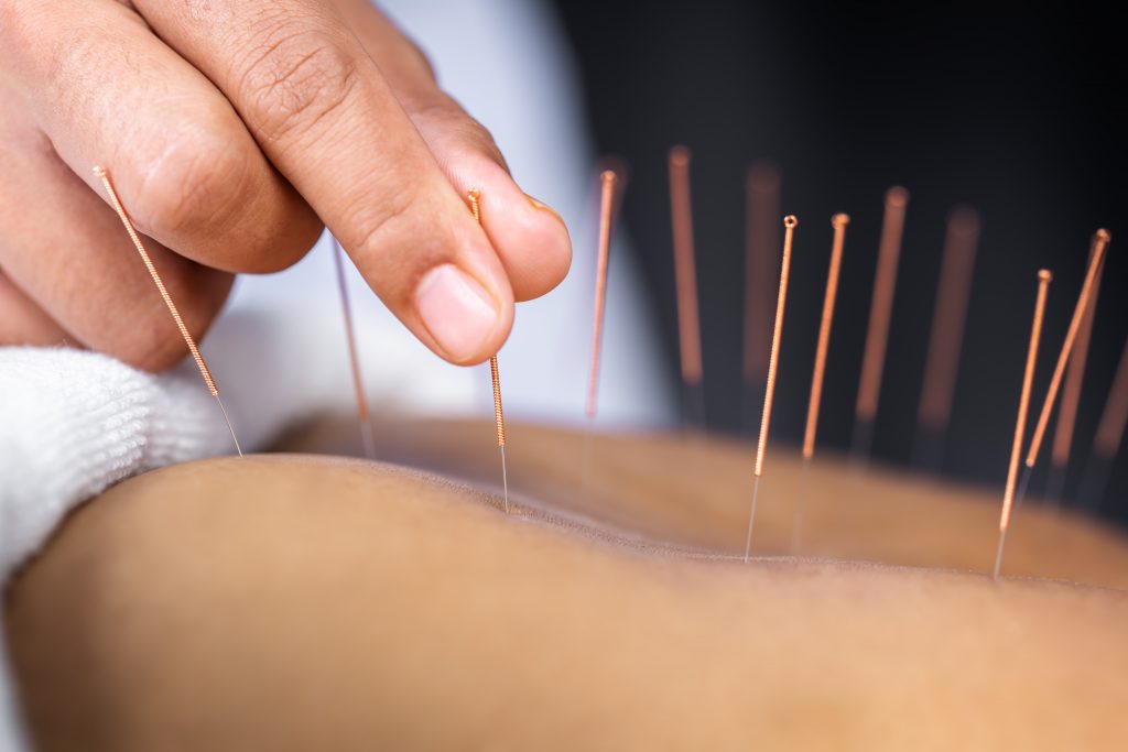 With acupuncture North York, the right balance can achieve post thumbnail image