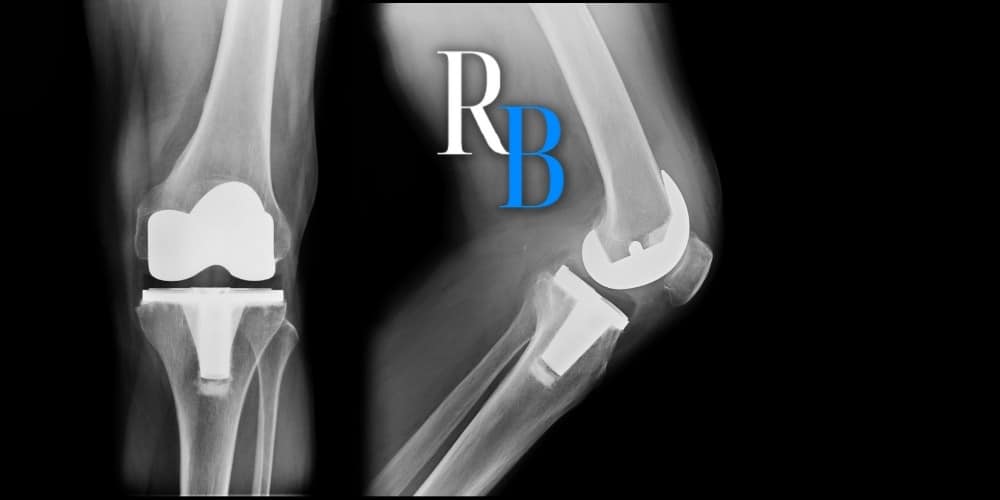 About the Recalled Exactech Joint Replacement Methods post thumbnail image
