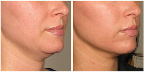 Just what is the rate of success of a face lifting treatment? post thumbnail image